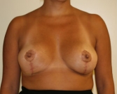 Feel Beautiful - Breast Reduction San Diego 9 - After Photo